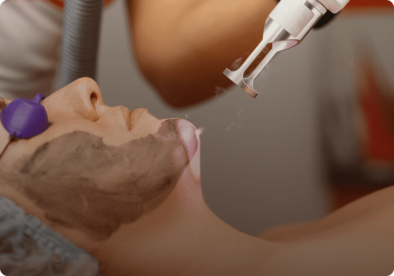 Woman undergoing laser skincare